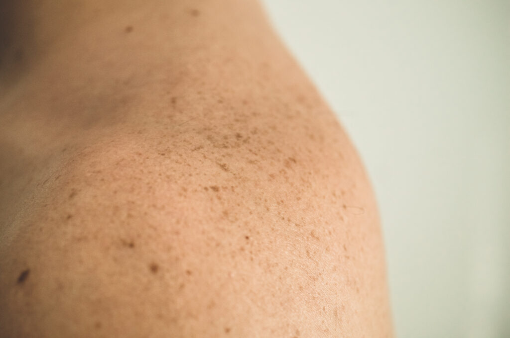 Ketamine therapy for shingles-related nerve pain